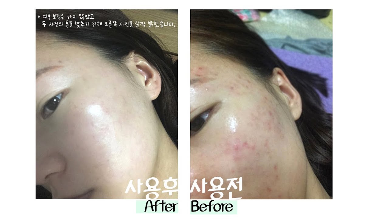 2 Pieces Dong-A Pharm Noscarna Acne Scars Removal Gels Face Facial Creams Large Size 20g Best help for getting rid of pimples De