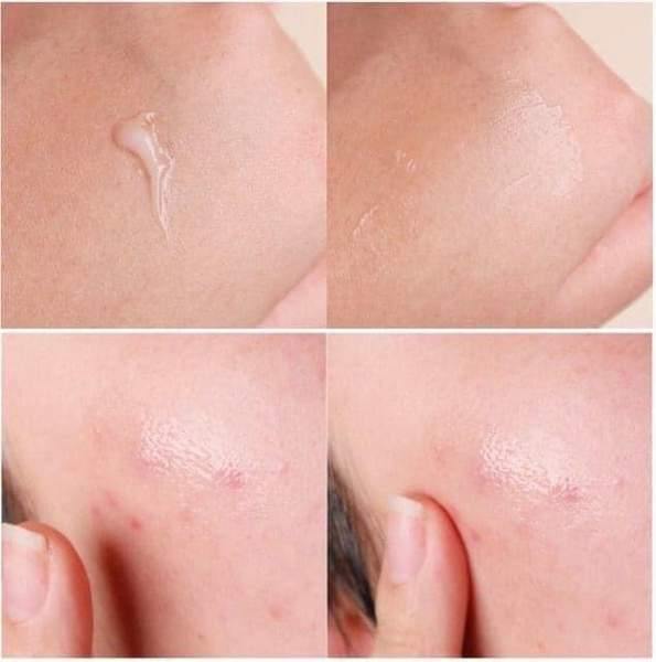 5 Pieces Dong-A Pharm Noscarna Acne Scars Removal Gels Face Facial Creams Large Size 20g Best help for getting rid of pimples De